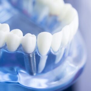 all on four Concetto di trattamento All-on-4®