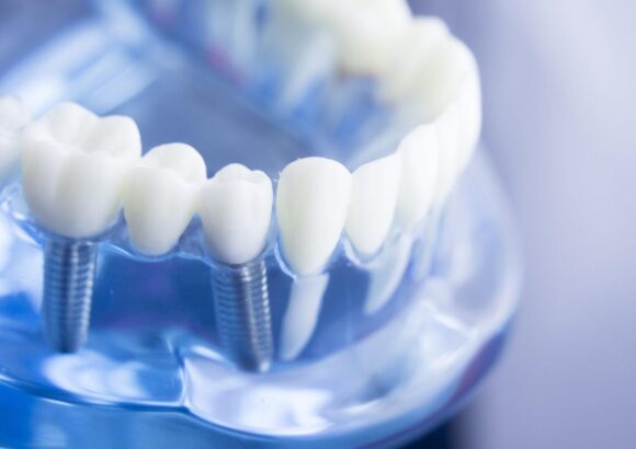 Concetto di trattamento All-on-4®