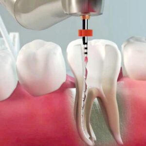 endodonzia Endodonzia