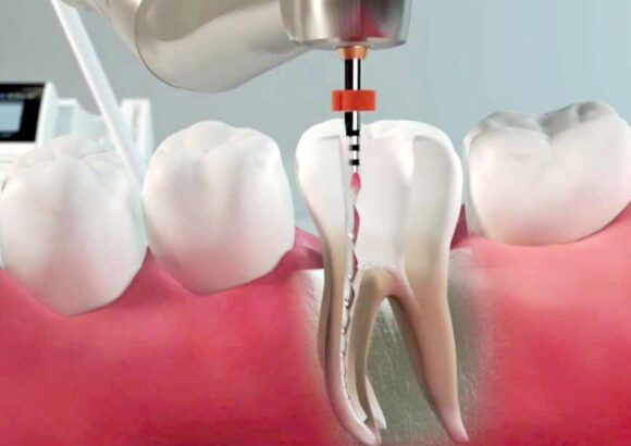Endodonzia