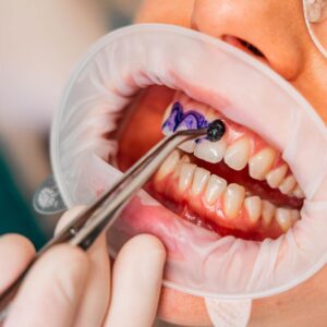igiene dentale Igiene